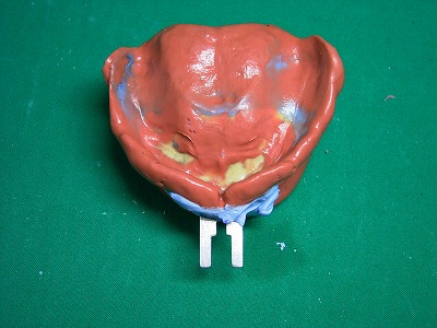 BPS義歯