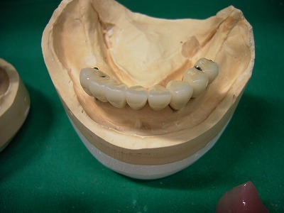 BPS義歯
