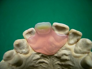 ノンクラスプ義歯