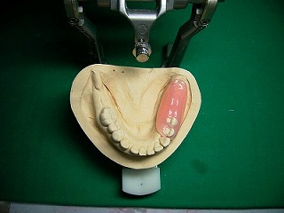 ノンクラスプ義歯