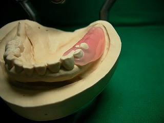 ノンクラスプ義歯