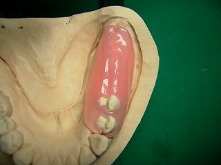 ノンクラスプ義歯