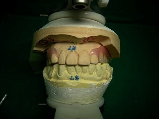 ノンクラスプ義歯