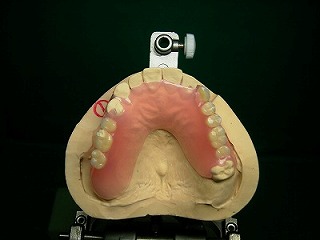 ノンクラスプ義歯