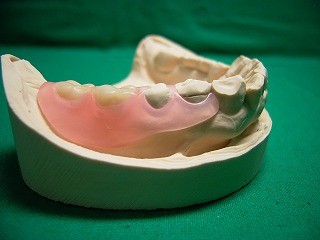 ノンクラスプ義歯