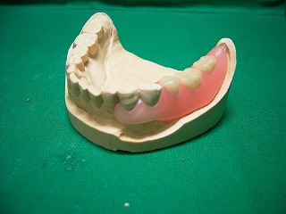 ノンクラスプ義歯