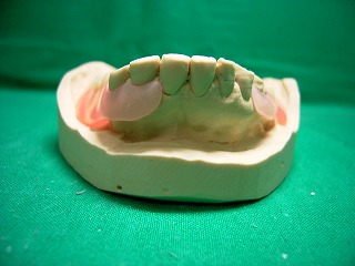 ノンクラスプ義歯
